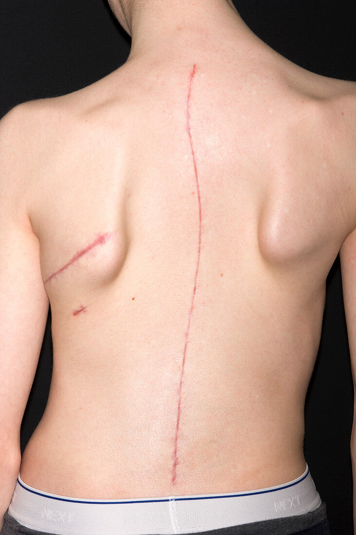 Scoliosis treatment scars