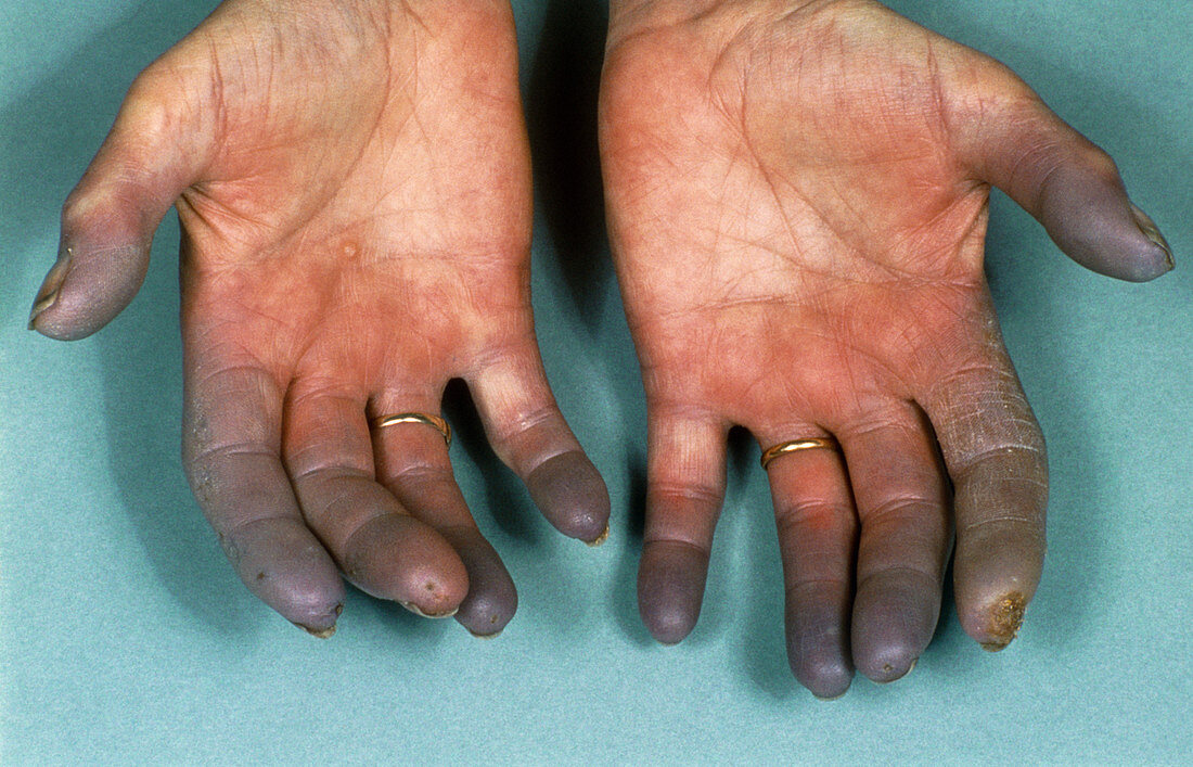 Hands of sufferer with Raynaud's disease