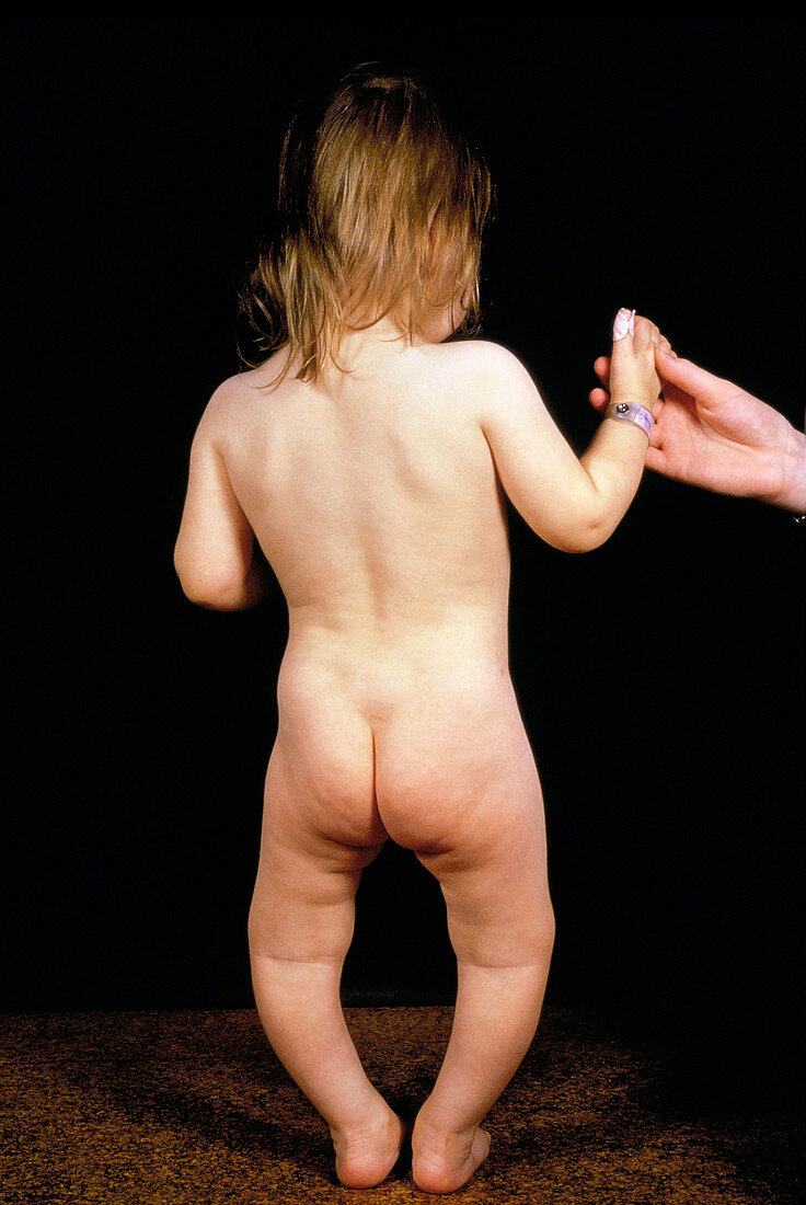 Child with rickets