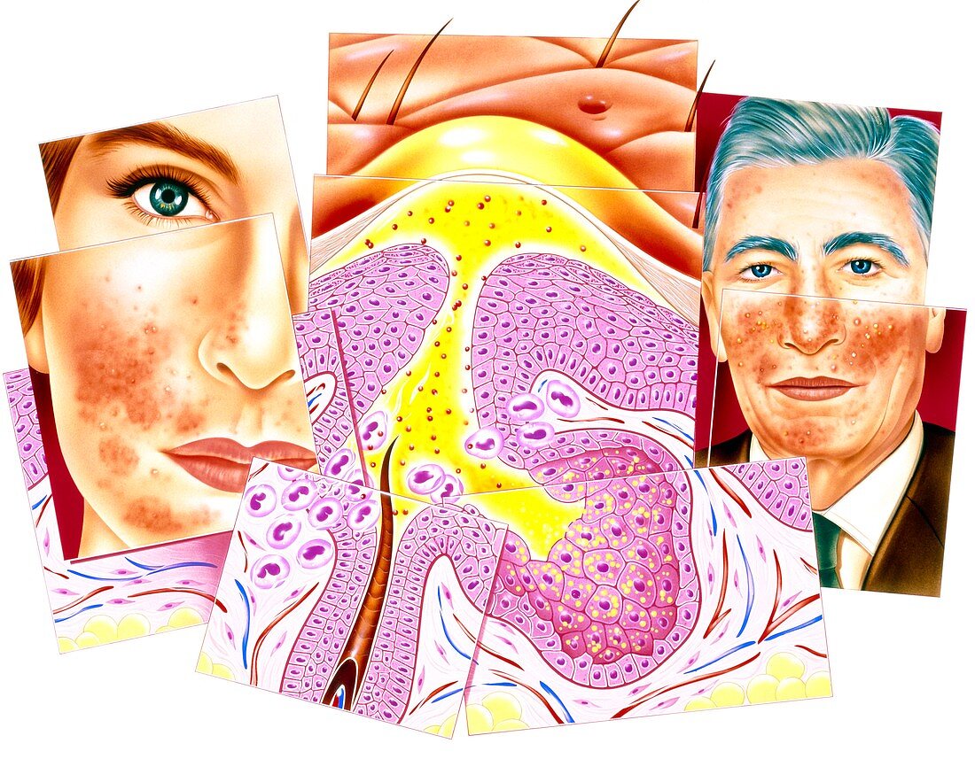 Artwork showing effects of Rosacea skin disorder