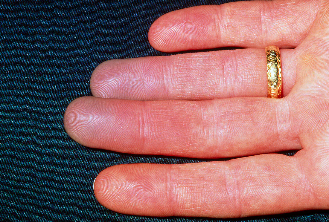 Raynaud's phenomenon seen on woman's fingers