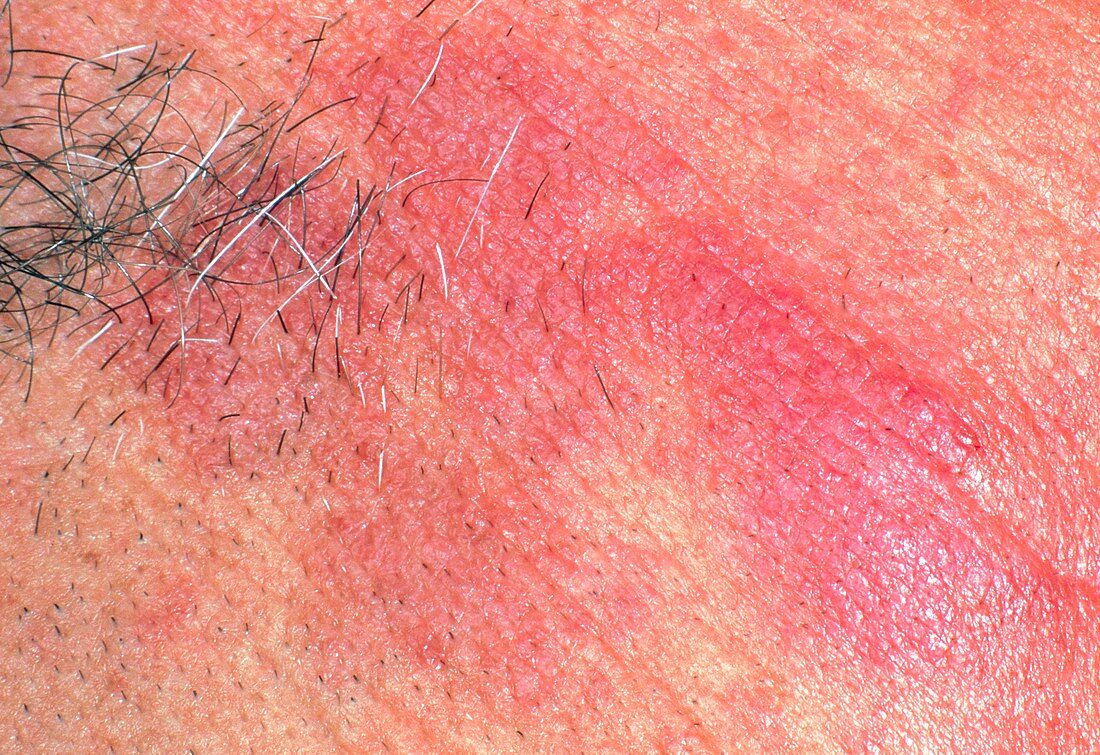 Rosacea affecting the skin on a man's face