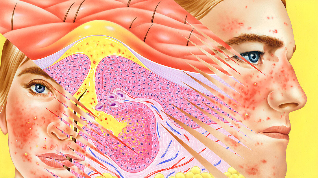 Rosacea skin disorder