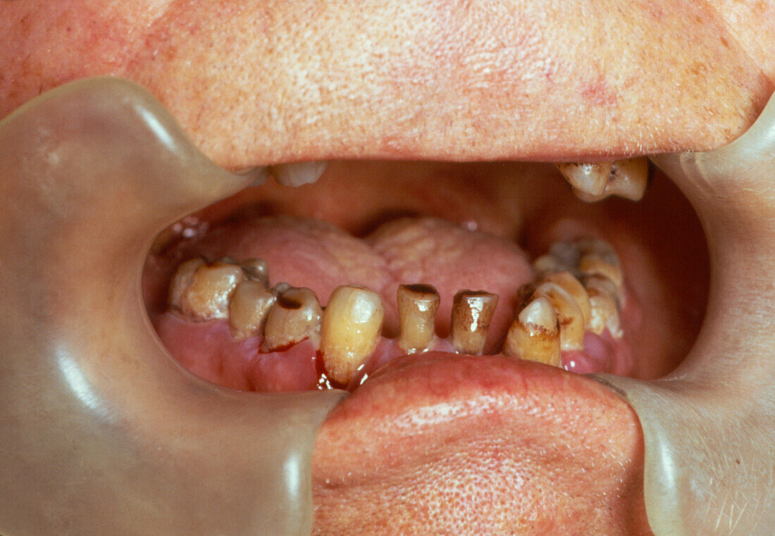 Scurvy affecting gums of the human mouth