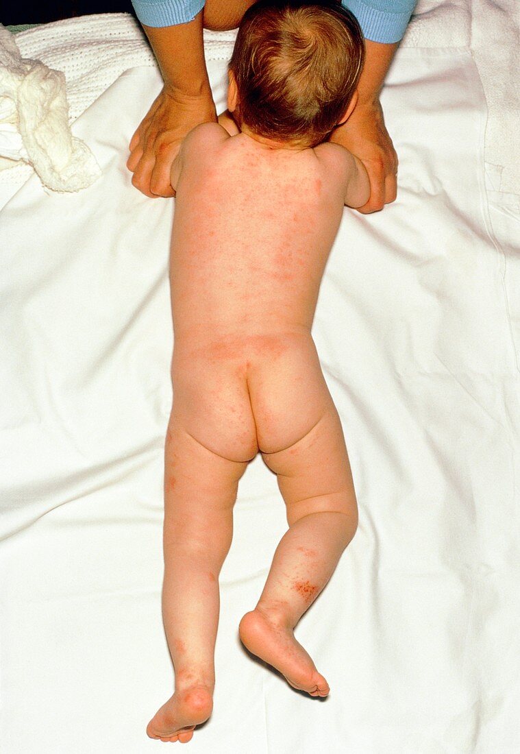 Child with scabies infection