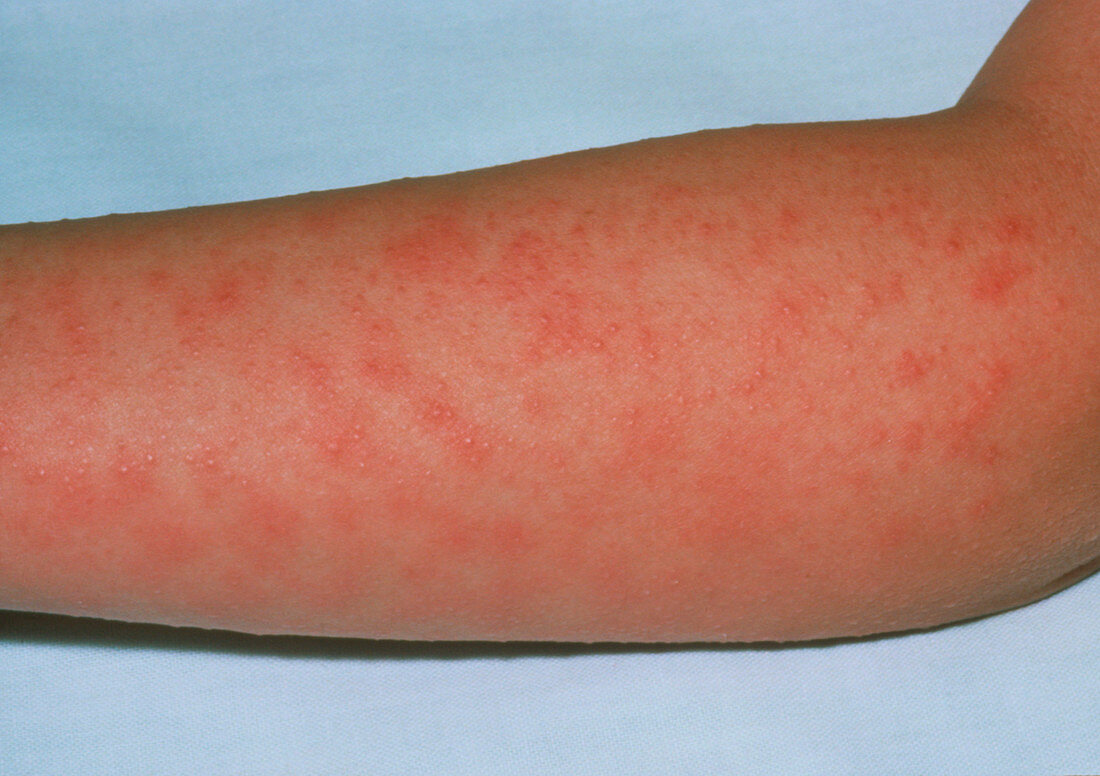 Scarlet fever rash on a patient's arm