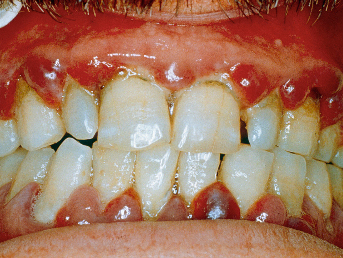 Swollen inflamed gums in scurvy