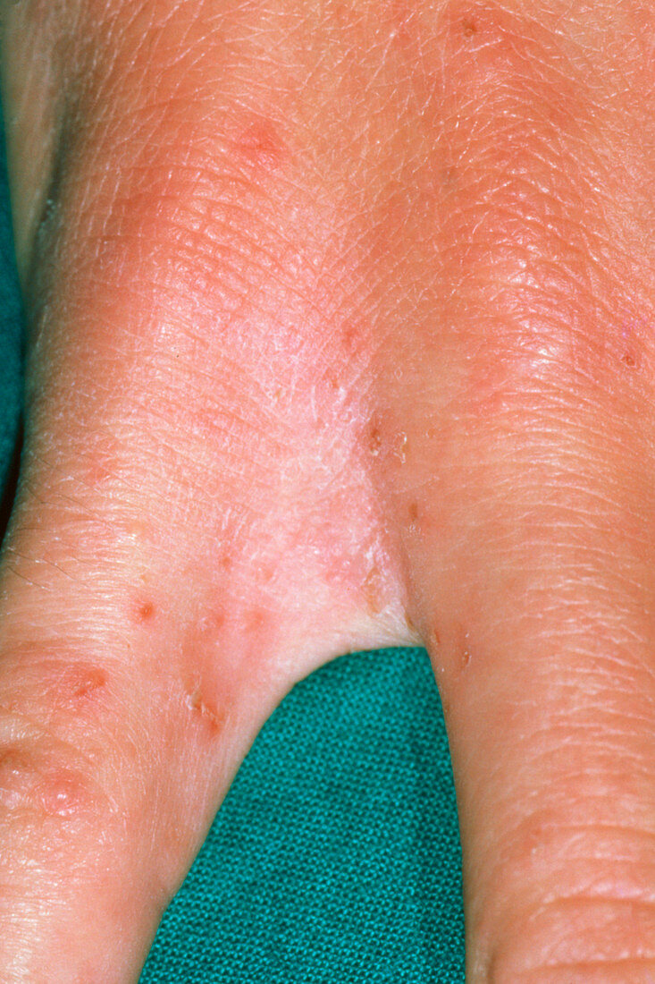Scabies infestation between fingers
