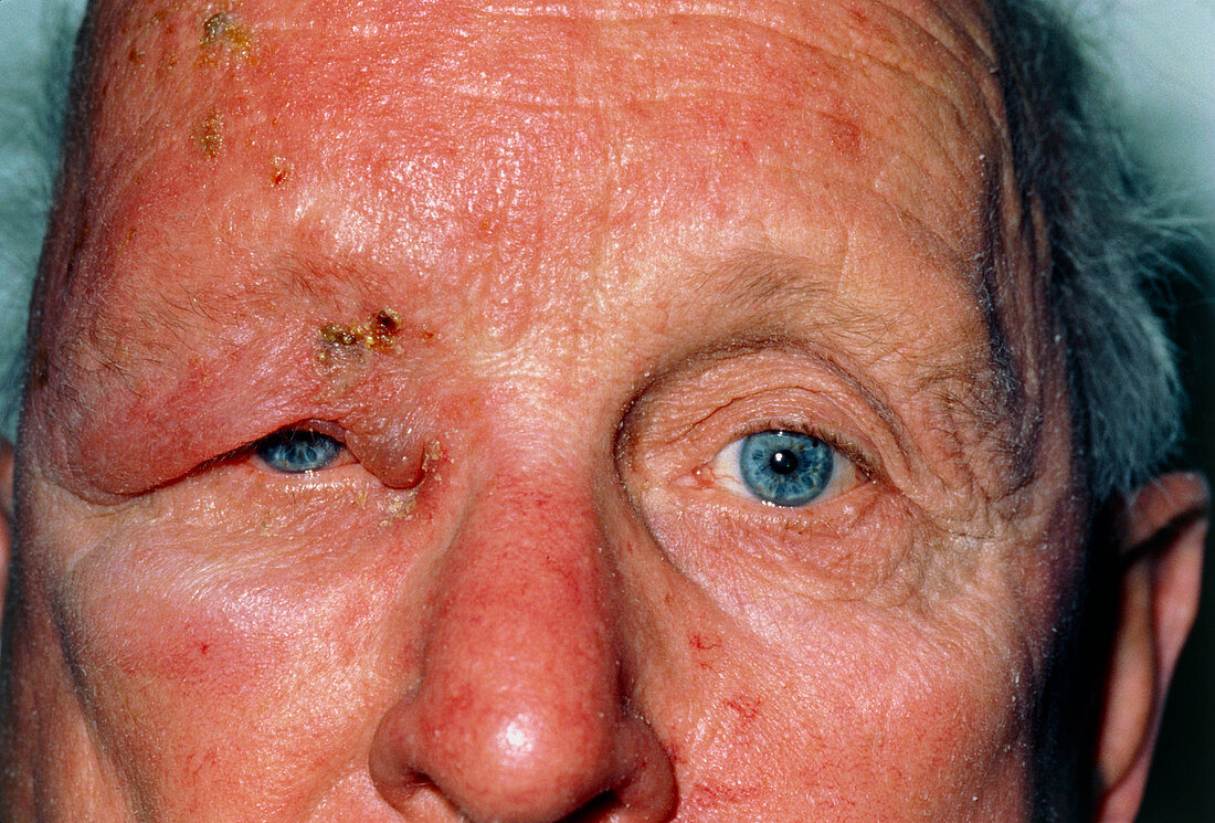Man affected by shingles (herpes zoster)