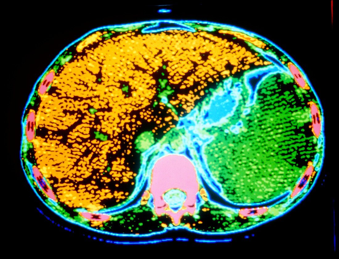 Coloured CT scan showing enlarged spleen