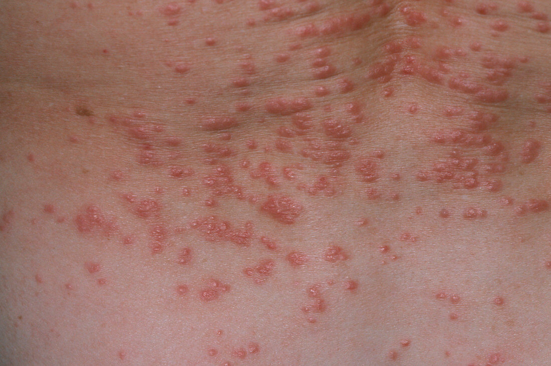 Red papules (lumps) on the skin due to scabies