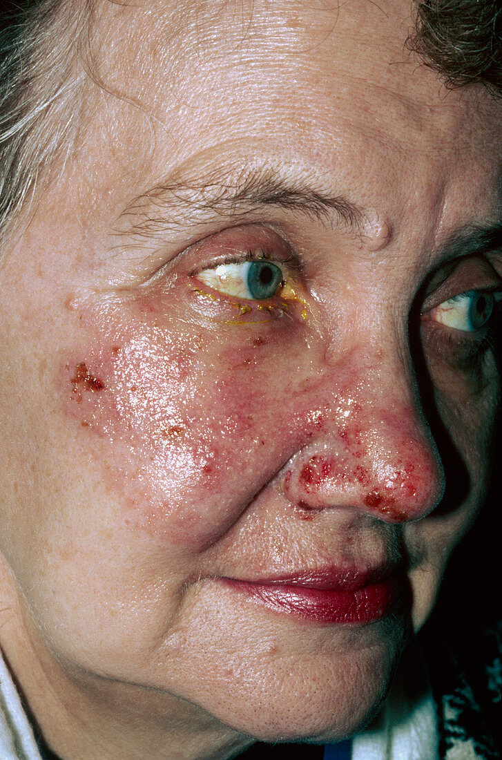 Herpes zoster blisters on woman's face
