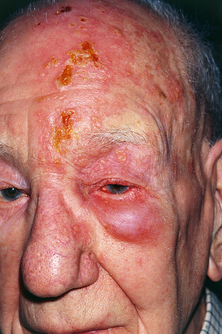Shingles attack on head of elderly male,1st day