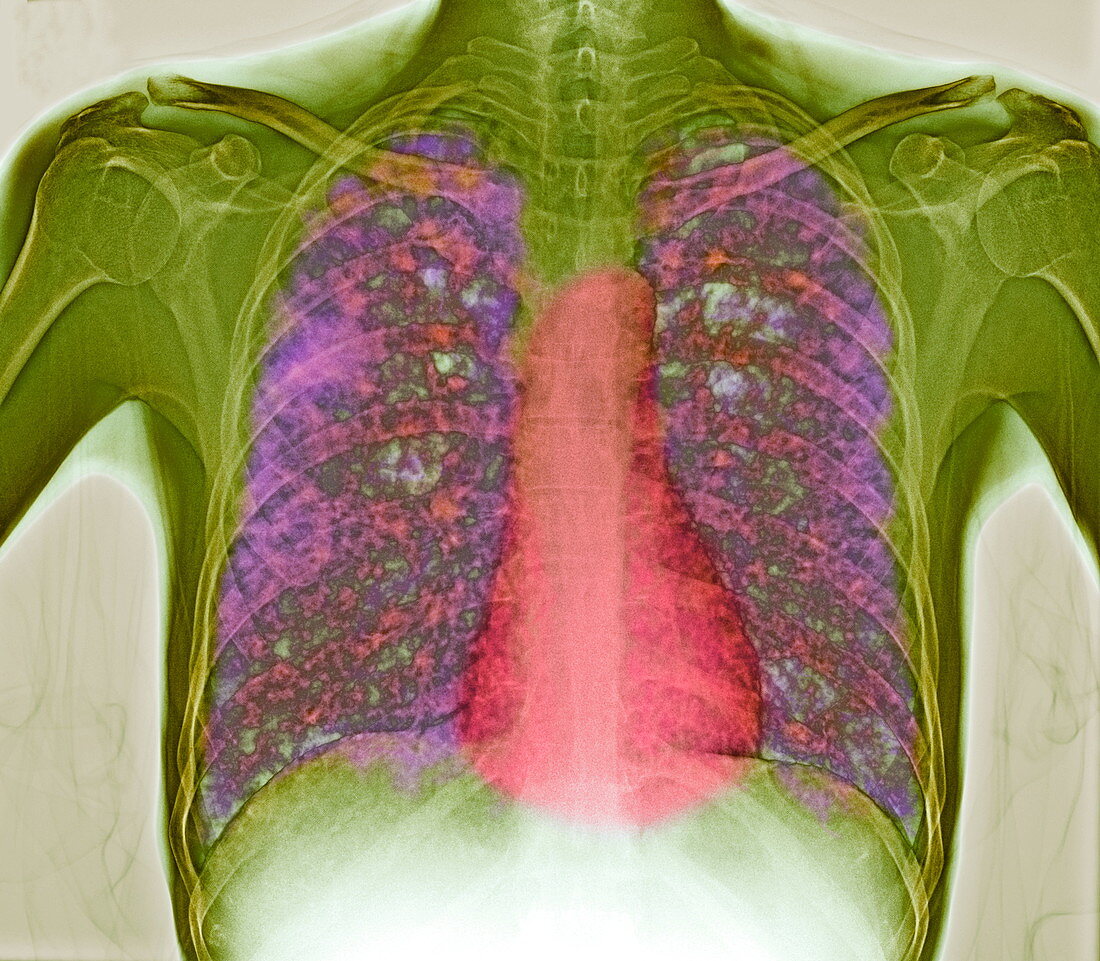 Tuberculosis,X-ray