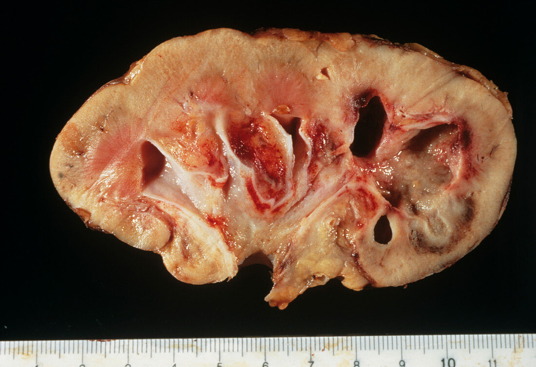 Kidney damaged by tuberculosis