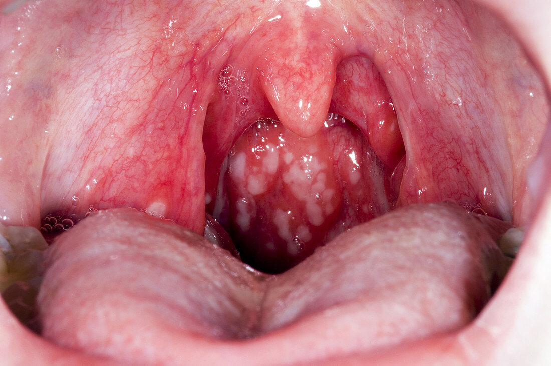 Inflamed tonsils