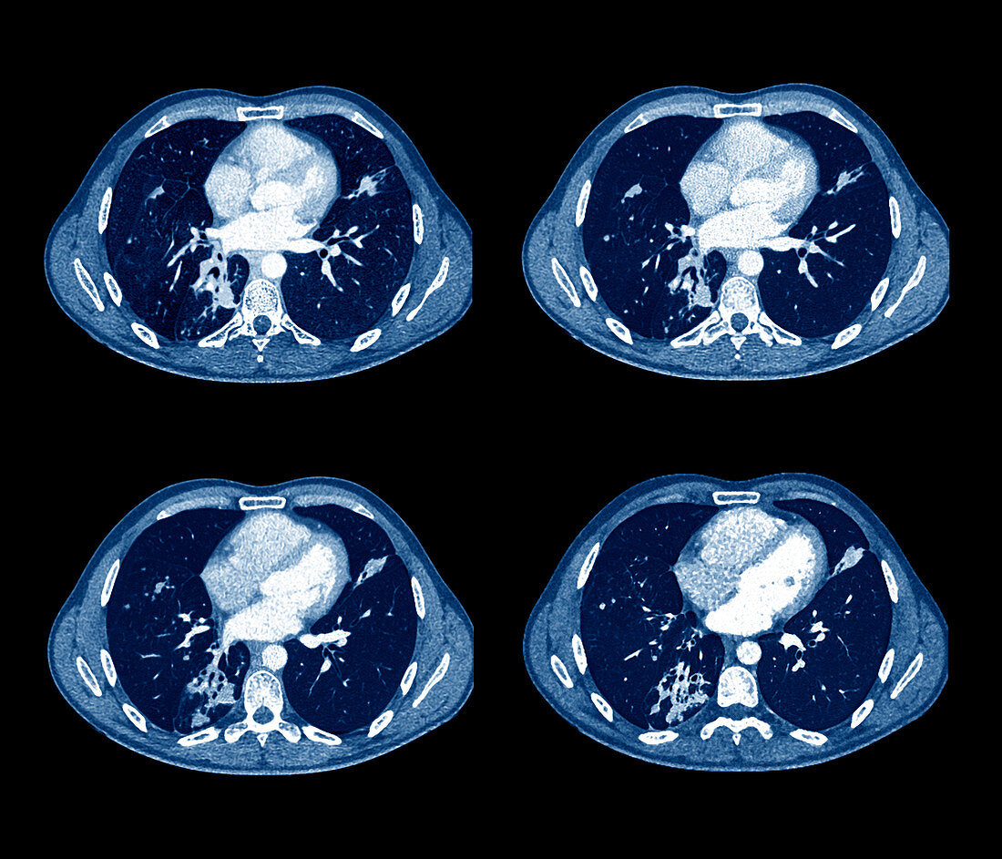 Tuberculosis,CT scans