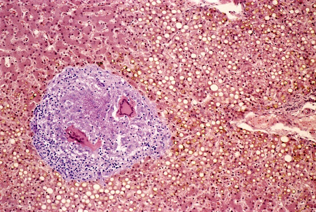 Liver tuberculosis,light micrograph