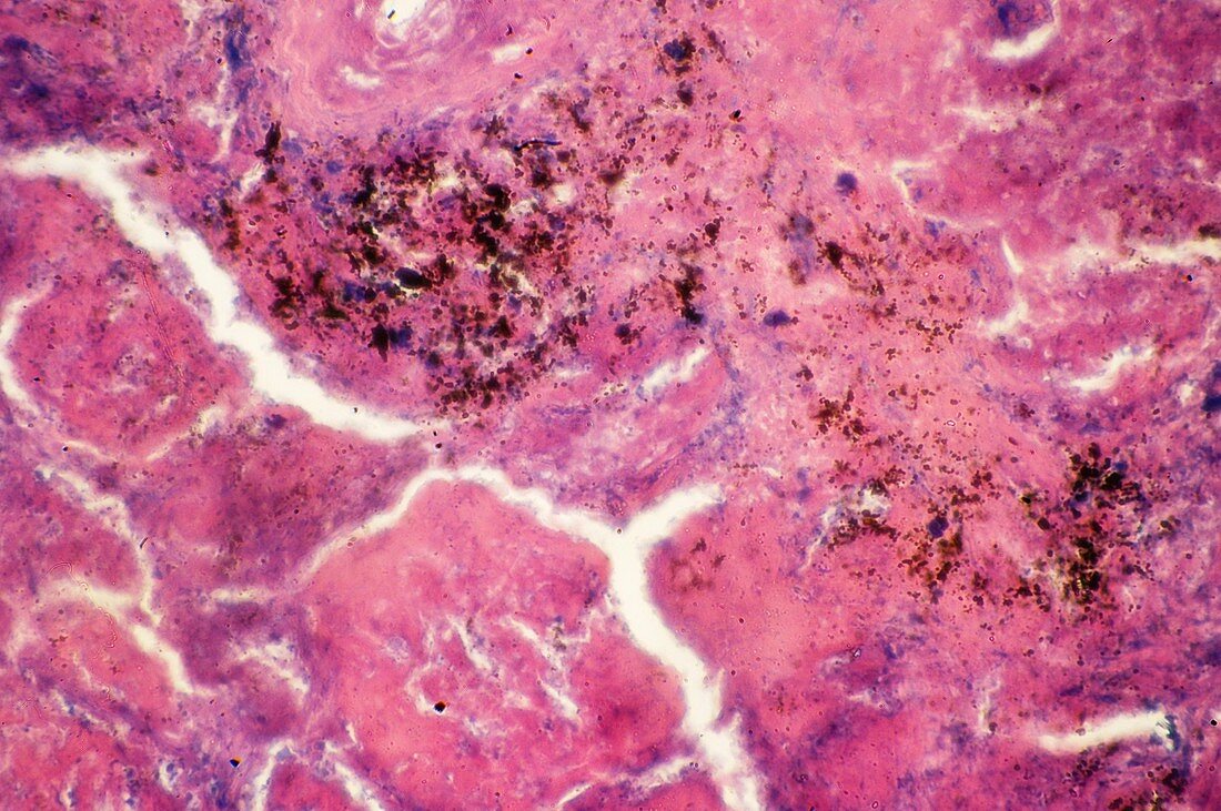 Pulmonary tuberculosis,light micrograph