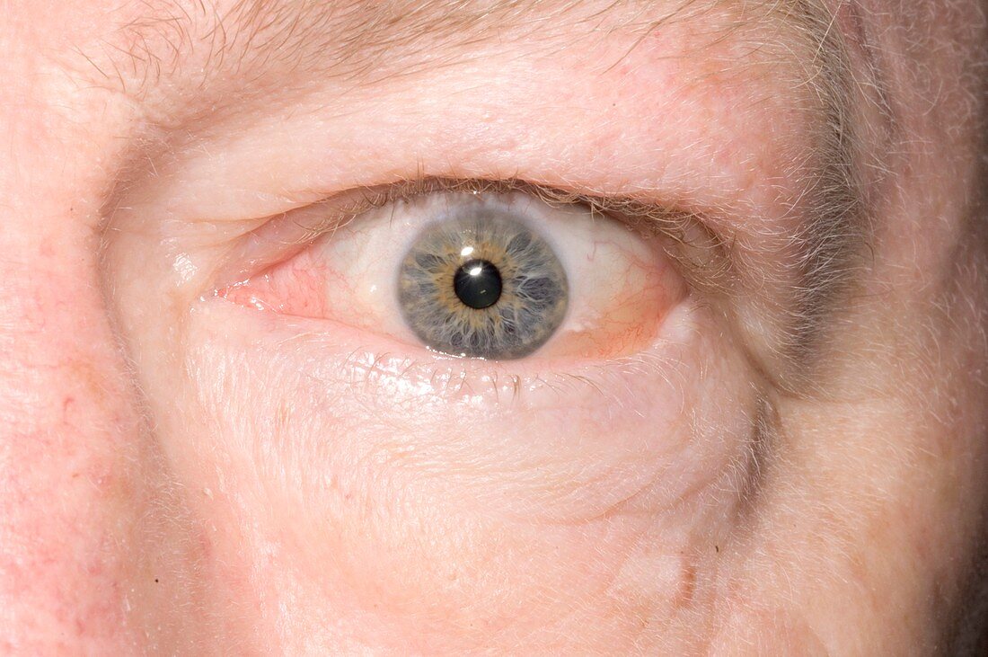 Swollen eye in thyrotoxicosis