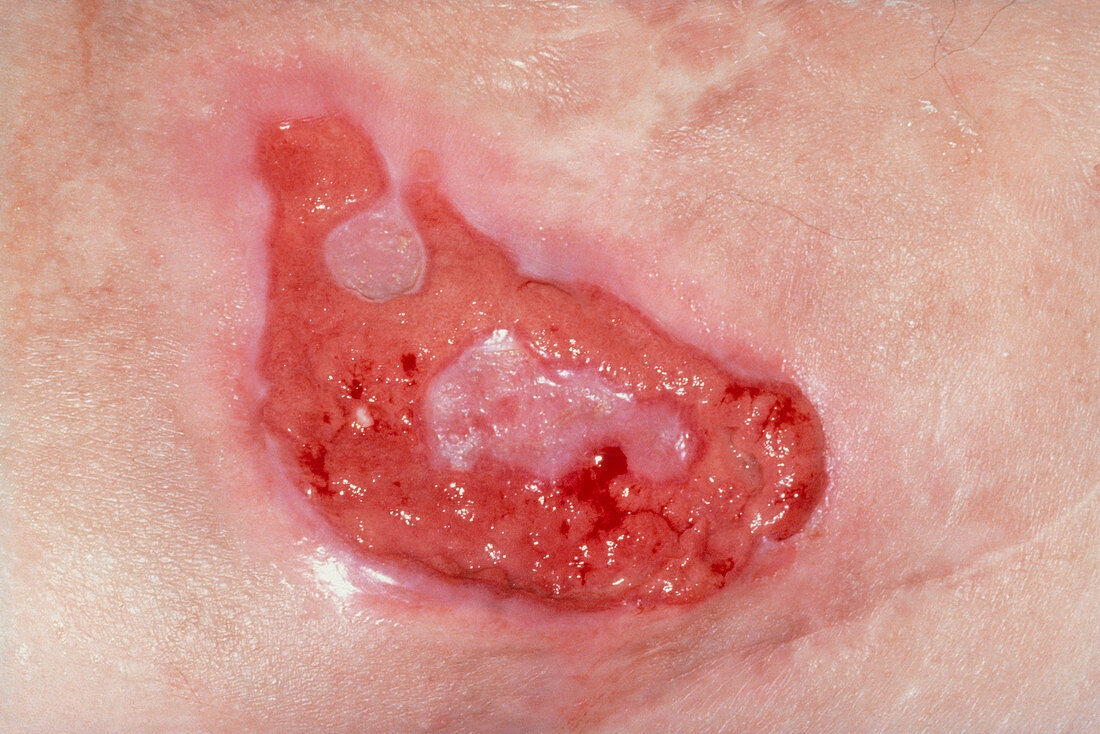 Close up of bed sore on elderly womans buttock