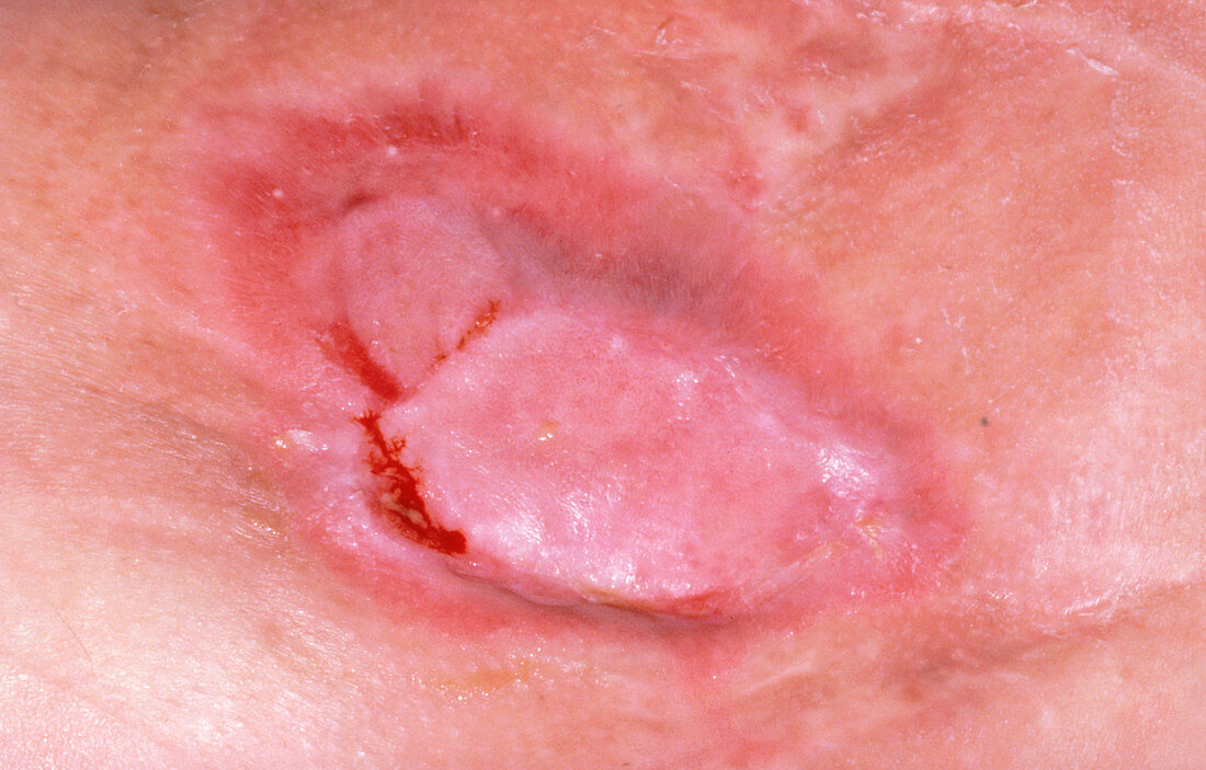 Close-up of partially healed bedsore on woman
