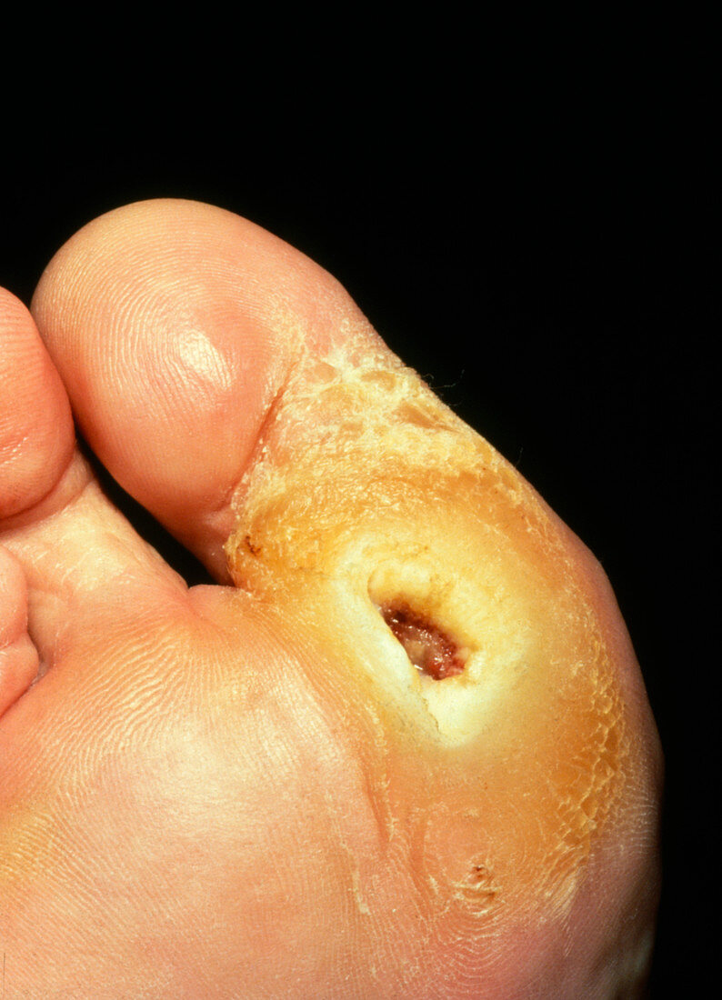 Diabetic neuropathy: ulceration of sole of foot