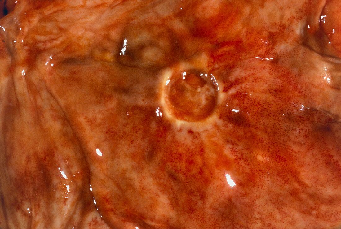 Photo of the foot showing diabetic ulcer