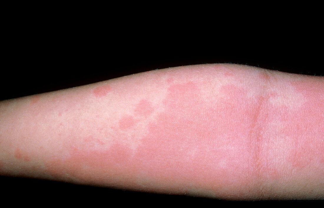 Urticaria; rash on arm