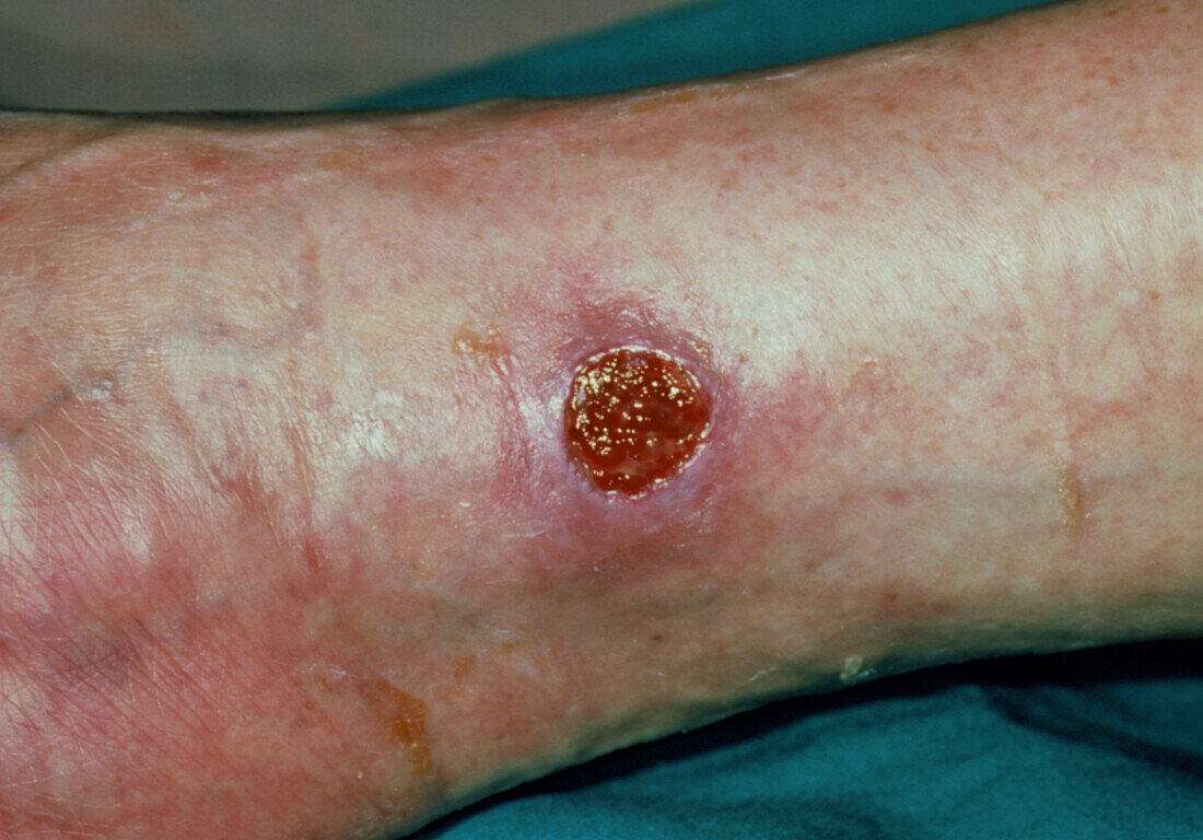 Close up of ankle showing venous ulcer