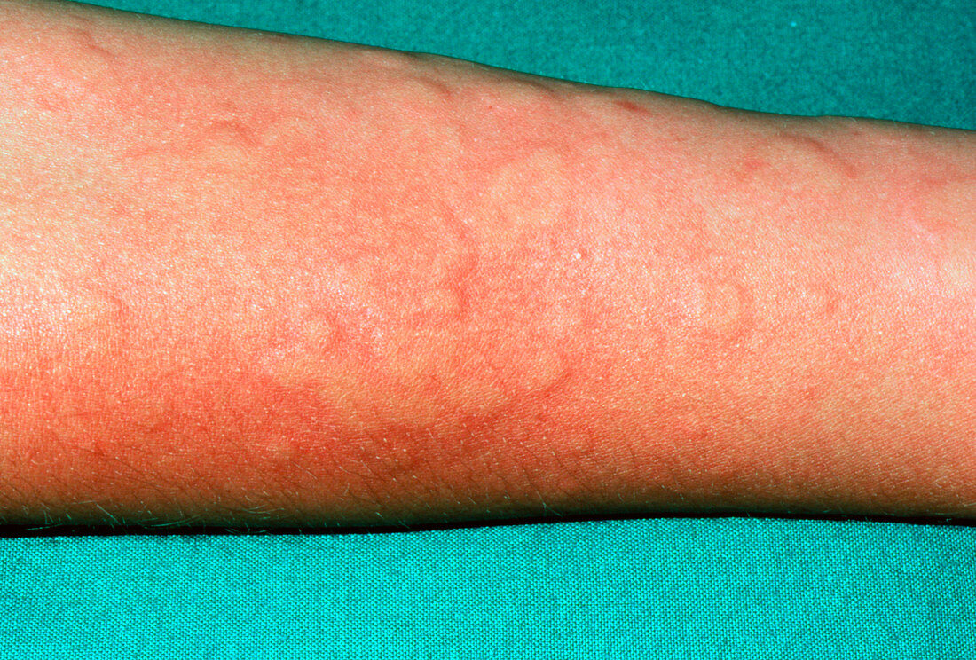 Urticaria,skin rash on an arm
