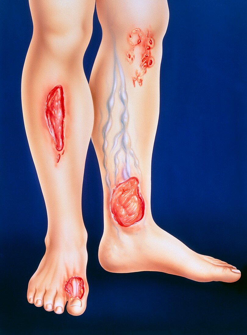 Artwork showing different types of leg ulcer