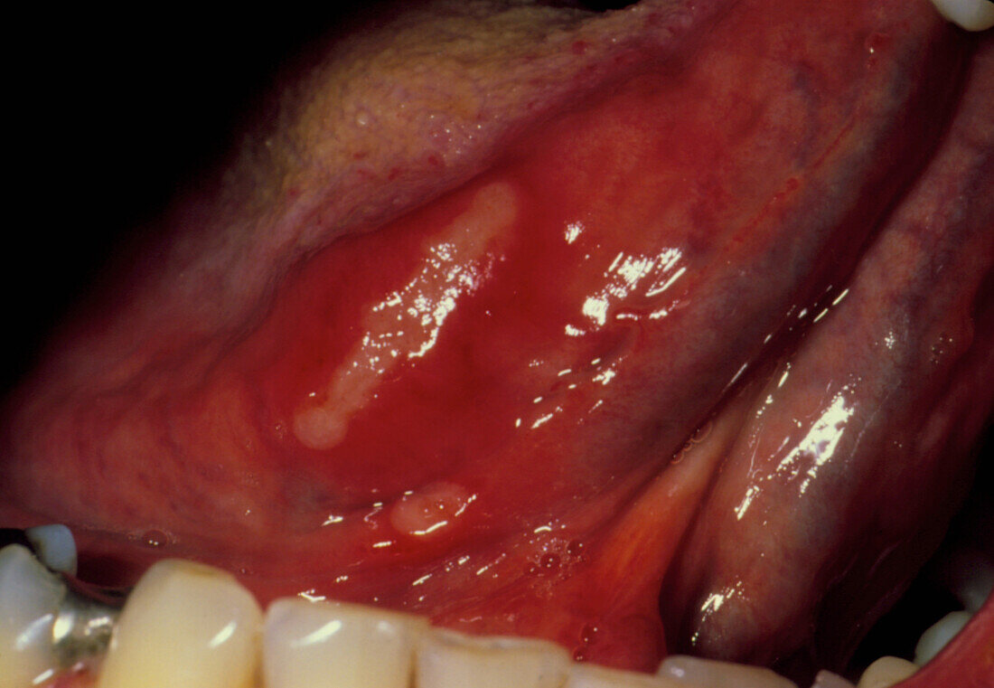 Close-up of aphthous ulcer under patient's tongue
