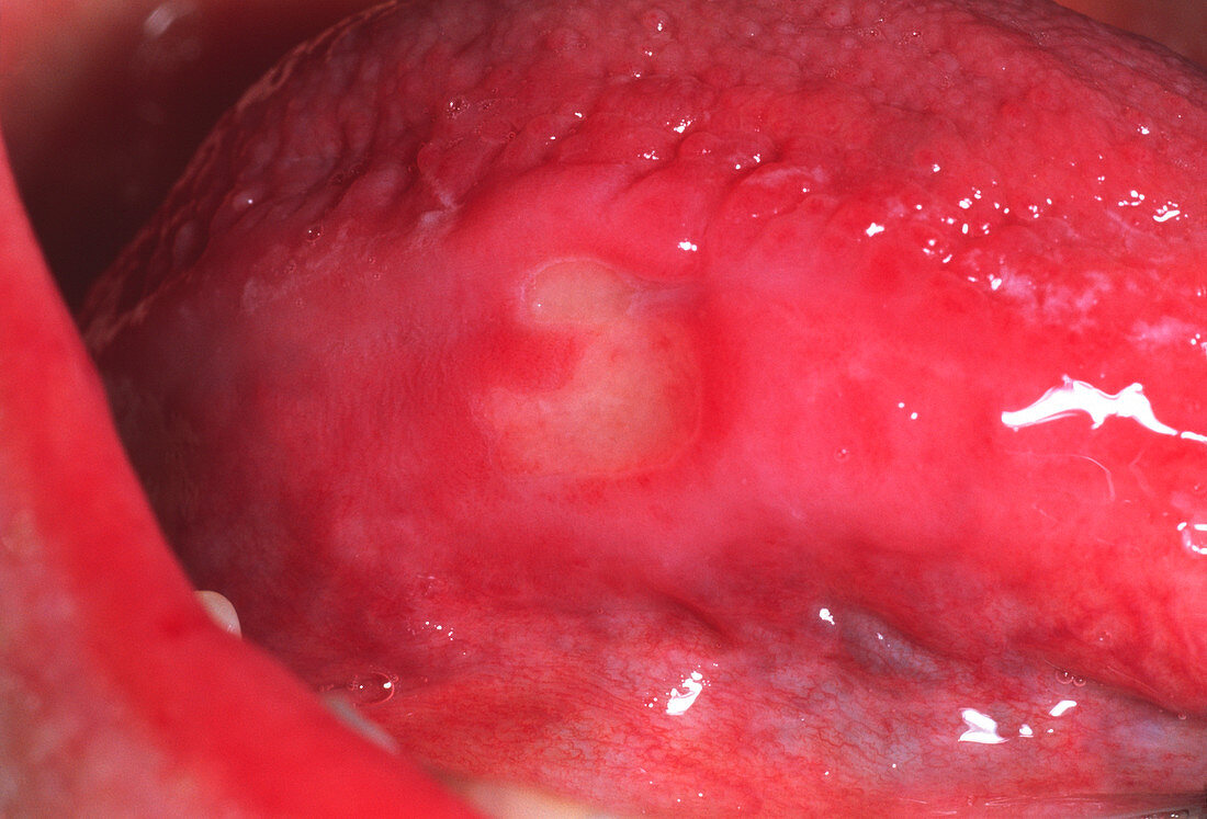 Tongue ulcer