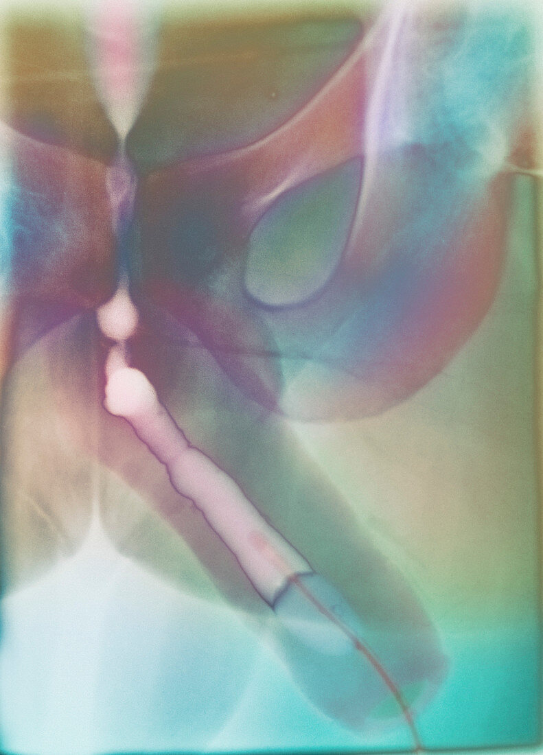 Urethritis,X-ray