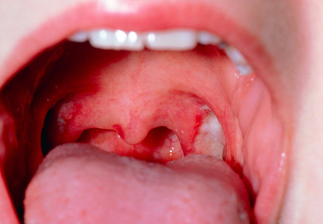 Patient's throat ten days after tonsillectomy