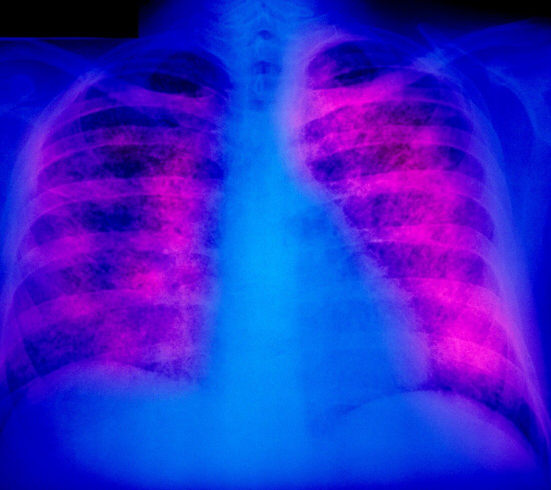 False-colour chest X-ray: miliary tuberculosis