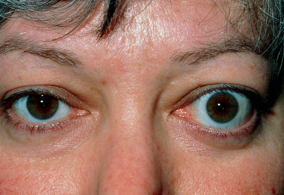 Bulging eye (exophthalmos) due to thyrotoxicosis