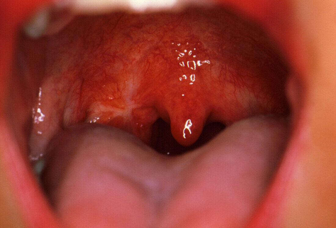 Woman's throat ten years after tonsillectomy