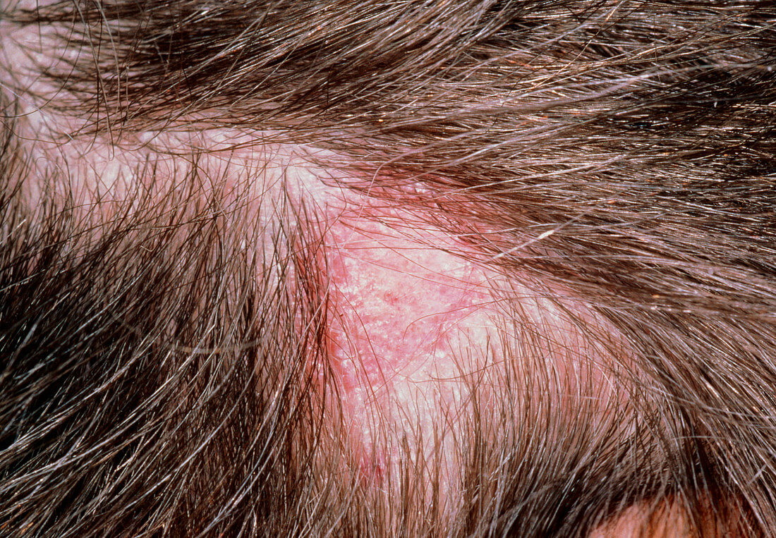 Tinea capitis: ringworm of the scalp (lesion)