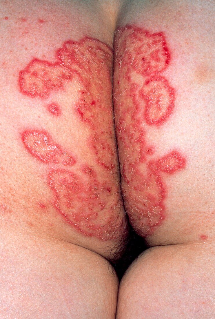 Woman's buttocks showing tinea (fungus) infection