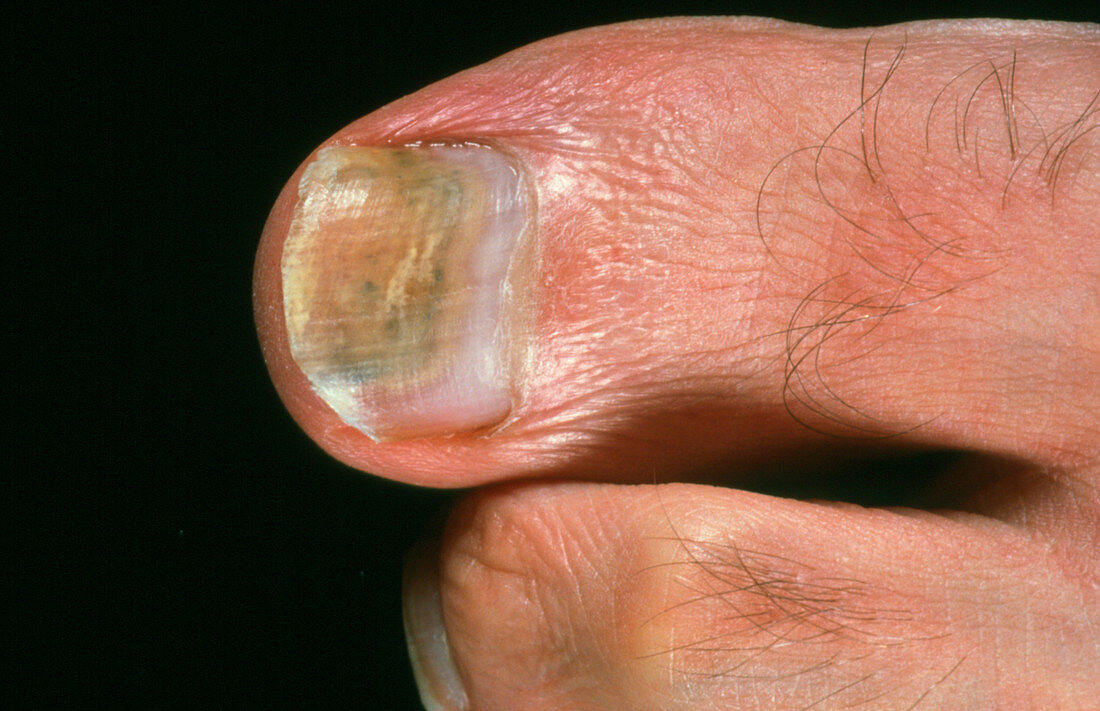 Toenail midway through fungal infection treatment