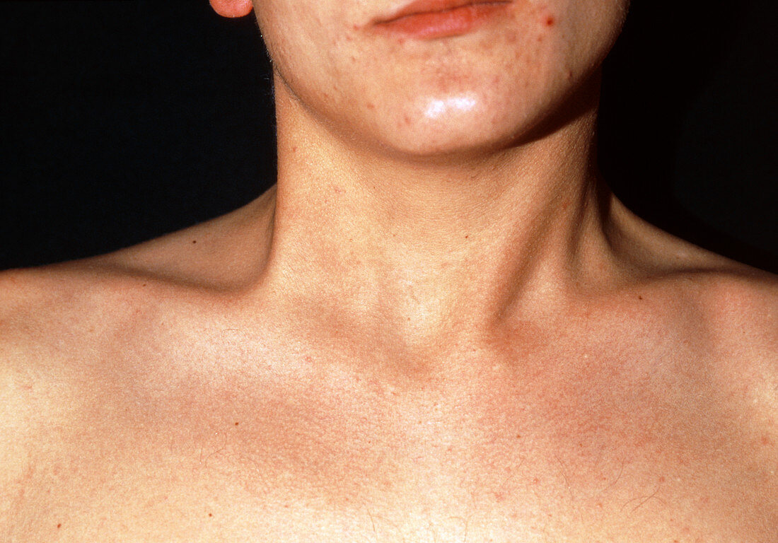 Torticollis in the neck of a 20 year old man