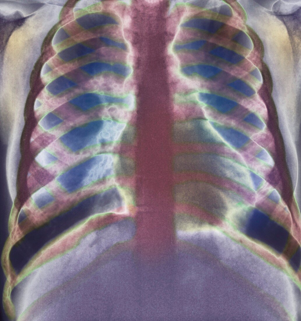 Thalassaemia,X-ray