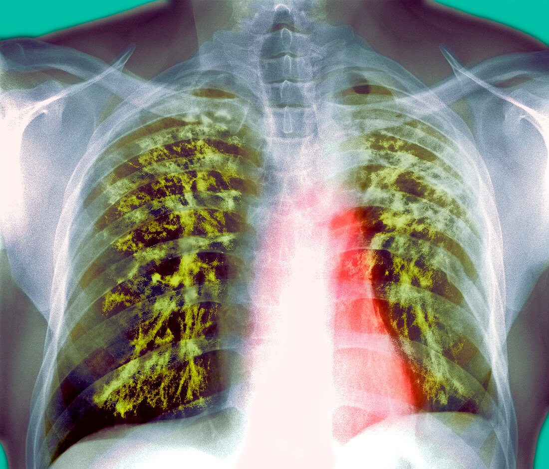 Lung scarring from tuberculosis,X-ray