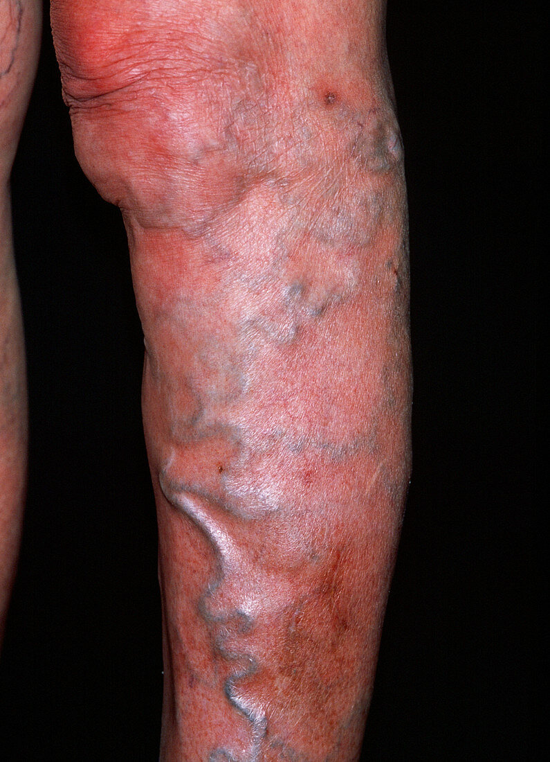 Varicose veins