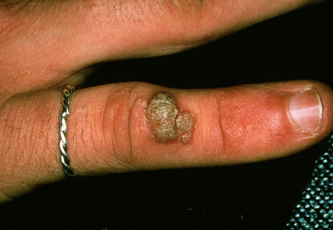 Common wart