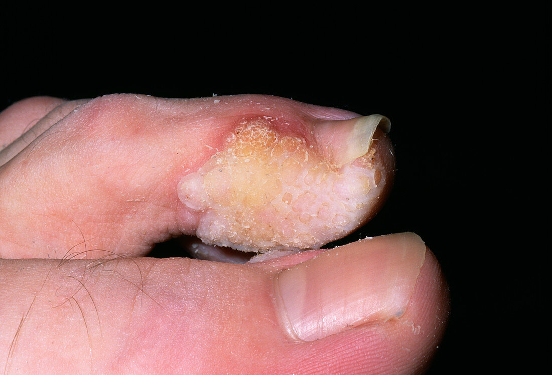 Warts on a toe