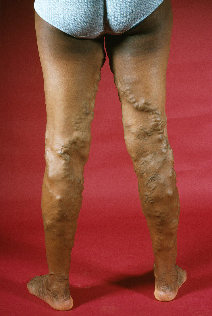 Varicose veins