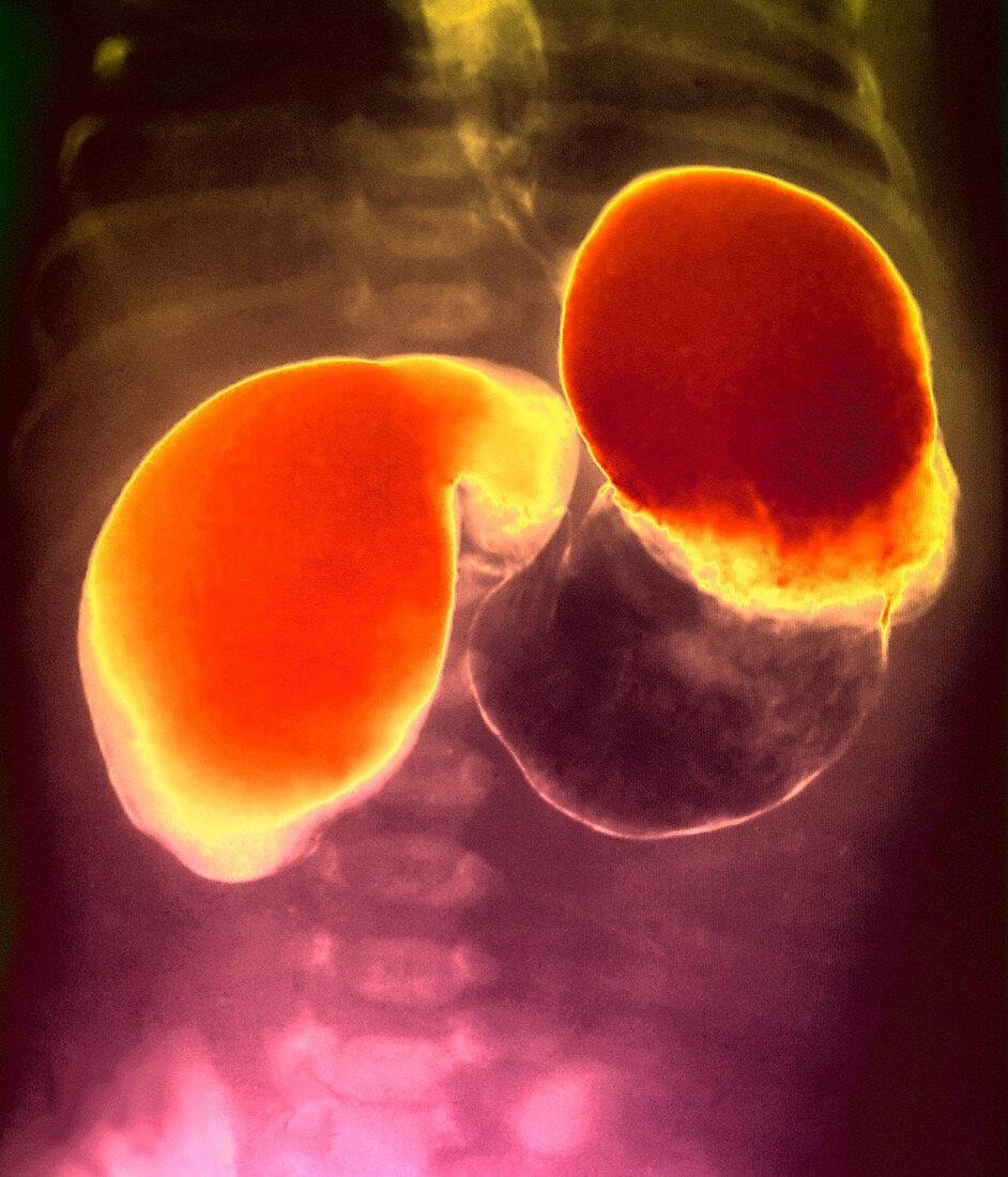 Twisted small intestine,X-ray